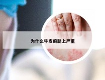 为什么牛皮癣腿上严重