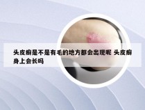 头皮癣是不是有毛的地方都会出现呢 头皮癣身上会长吗