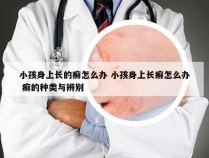 小孩身上长的癣怎么办 小孩身上长癣怎么办 癣的种类与辨别