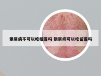 银屑病不可以吃榴莲吗 银屑病可以吃留莲吗