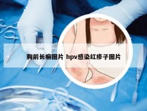 胸前长癣图片 hpv感染红疹子图片