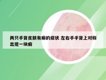 两只手背皮肤有癣的症状 左右手手背上对称出现一块癣