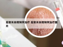 后背长白斑如何治疗 后背长白斑如何治疗图片