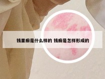 钱里癣是什么样的 钱癣是怎样形成的