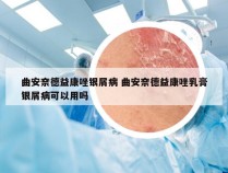 曲安奈德益康唑银屑病 曲安奈德益康唑乳膏银屑病可以用吗