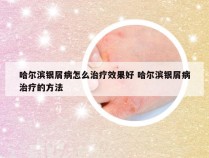 哈尔滨银屑病怎么治疗效果好 哈尔滨银屑病治疗的方法