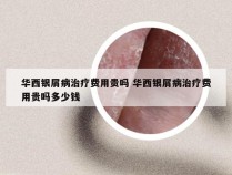 华西银屑病治疗费用贵吗 华西银屑病治疗费用贵吗多少钱