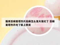 服用百癣夏塔热片后癣怎么变大变红了 百癣夏塔热片吃了脸上脱皮