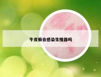 牛皮癣会感染生殖器吗