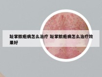 趾掌脓疱病怎么治疗 趾掌脓疱病怎么治疗效果好