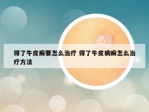 得了牛皮癣要怎么治疗 得了牛皮病癣怎么治疗方法