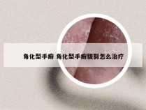 角化型手癣 角化型手癣皲裂怎么治疗