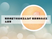 银屑病留下的白斑怎么治疗 银屑病有白点怎么回事