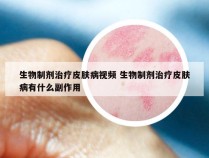 生物制剂治疗皮肤病视频 生物制剂治疗皮肤病有什么副作用