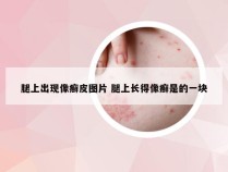 腿上出现像癣皮图片 腿上长得像癣是的一块