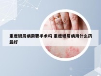 重度银屑病需要手术吗 重度银屑病用什么药最好