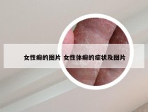 女性癣的图片 女性体癣的症状及图片