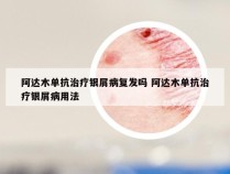 阿达木单抗治疗银屑病复发吗 阿达木单抗治疗银屑病用法