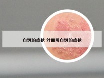 白斑的症状 外面阴白斑的症状