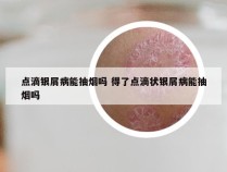 点滴银屑病能抽烟吗 得了点滴状银屑病能抽烟吗