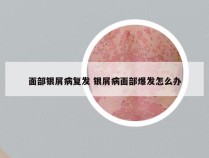 面部银屑病复发 银屑病面部爆发怎么办