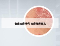 普通皮癣痒吗 皮癣奇痒无比