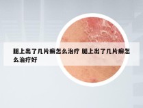 腿上出了几片癣怎么治疗 腿上出了几片癣怎么治疗好