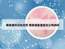 银屑病可以吃攻然 银屑病患者能吃公鸡肉吗