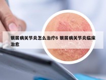 银屑病关节炎怎么治疗6 银屑病关节炎临床治愈