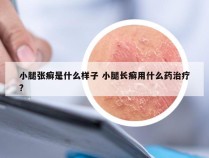 小腿张癣是什么样子 小腿长癣用什么药治疗?