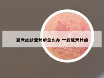 夏天皮肤爱长癣怎么办 一到夏天长癣