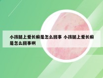 小孩腿上爱长癣是怎么回事 小孩腿上爱长癣是怎么回事啊