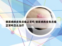 银屑病表皮有点痛正常吗 银屑病表皮有点痛正常吗怎么治疗