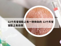 12个月宝宝脸上有一块块白的 12个月宝宝脸上有白斑