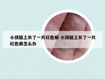 小孩腿上长了一片红色癣 小孩腿上长了一片红色癣怎么办