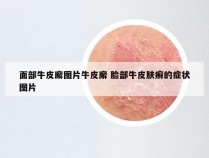 面部牛皮廨图片牛皮廨 脸部牛皮肤癣的症状图片