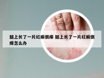 腿上长了一片红癣很痒 腿上长了一片红癣很痒怎么办