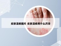 皮肤湿癣图片 皮肤湿癣用什么药膏