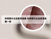 白斑做什么检查更准确 白斑做什么检查更准确一些