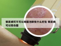 银屑病可不可以用醋泡脚有什么好处 银屑病可以擦白醋