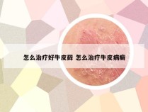 怎么治疗好牛皮藓 怎么治疗牛皮病癣