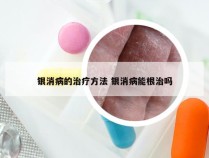 银消病的治疗方法 银消病能根治吗