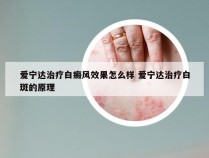 爱宁达治疗白癜风效果怎么样 爱宁达治疗白斑的原理