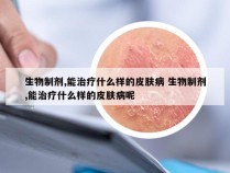 生物制剂,能治疗什么样的皮肤病 生物制剂,能治疗什么样的皮肤病呢