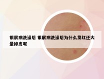 银屑病洗澡后 银屑病洗澡后为什么发红还大量掉皮呢