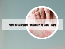 银屑病症状图集 银屑病图片 初期 病因