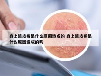 身上起皮癣是什么原因造成的 身上起皮癣是什么原因造成的呢