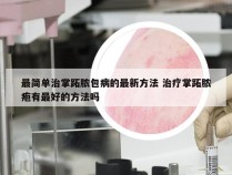 最简单治掌跖脓包病的最新方法 治疗掌跖脓疱有最好的方法吗