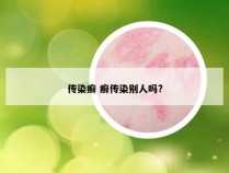 传染癣 癣传染别人吗?