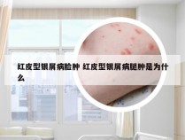 红皮型银屑病脸肿 红皮型银屑病腿肿是为什么